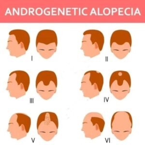 Androgenetic Alopecia