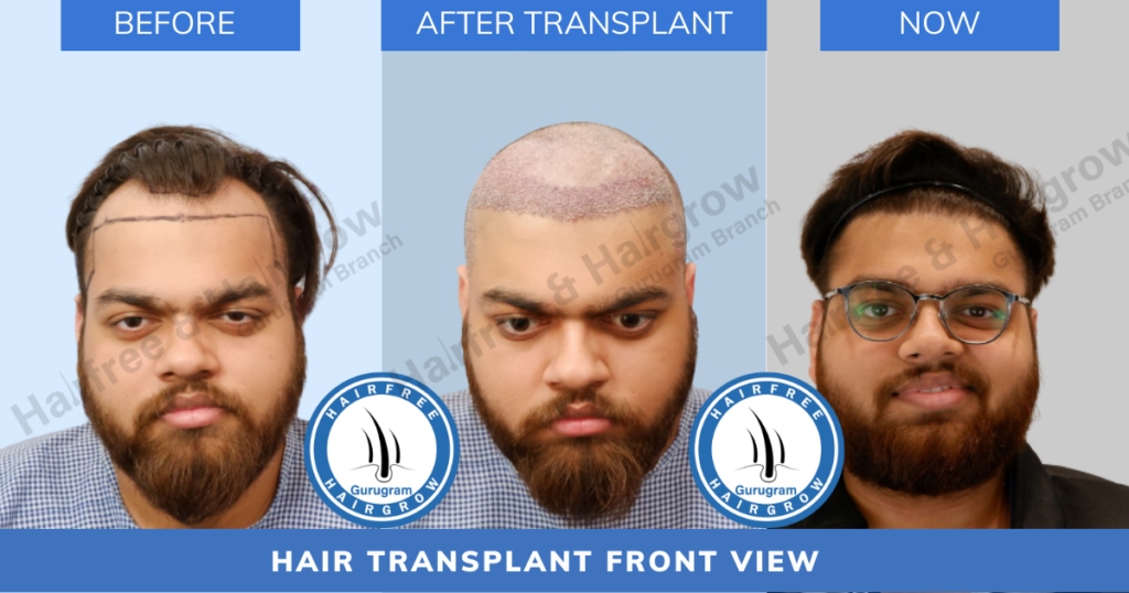 hair loss solution, hair loss treatment, hair loss treatment in Gururgam, hair free and hair grow, hairfree and hairgrow, hfhg, hairfree and hairgrow clinic, PRP treatment in Gurugram, best hair transplant clinic in Delhi, best hair transplant clinic in Gurugram, best hair transplant clinic in Gurgaon, affordable hair transplant clinic in Delhi, affordable hair transplant clinic in gurugram, hair transplant results in gurugram, hair transplant results in gurugram, hairfree and hairgrow clinic, hair transplant cost in Delhi, hair transplant cost in gurugram, affordable hair transplant in Delhi, affordable hair transplant in gurugram, hair free and hair grow clinic,hair free and hair grow clinic