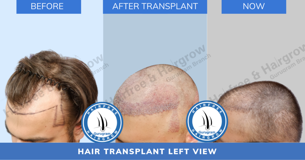 hair loss solution, hair loss treatment, hair loss treatment in Gururgam, hair free and hair grow, hairfree and hairgrow, hfhg, hairfree and hairgrow clinic, PRP treatment in Gurugram, best hair transplant clinic in Delhi, best hair transplant clinic in Gurugram, best hair transplant clinic in Gurgaon, affordable hair transplant clinic in Delhi, affordable hair transplant clinic in gurugram, hair transplant results in gurugram, hair transplant results in gurugram, hairfree and hairgrow clinic, hair transplant cost in Delhi, hair transplant cost in gurugram, affordable hair transplant in Delhi, affordable hair transplant in gurugram, hair free and hair grow clinic,hair free and hair grow clinic