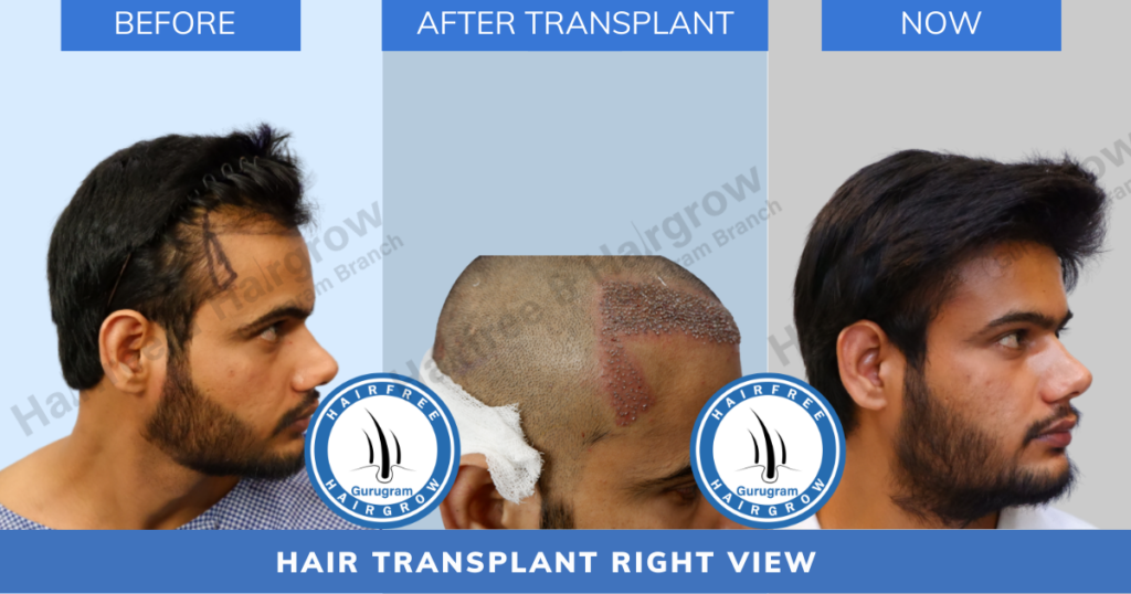 hair loss solution, hair loss treatment, hair loss treatment in Gururgam, hair free and hair grow, hairfree and hairgrow, hfhg, hairfree and hairgrow clinic, PRP treatment in Gurugram, best hair transplant clinic in Delhi, best hair transplant clinic in Gurugram, best hair transplant clinic in Gurgaon, affordable hair transplant clinic in Delhi, affordable hair transplant clinic in gurugram, hair transplant results in gurugram, hair transplant results in gurugram, hairfree and hairgrow clinic, hair transplant cost in Delhi, hair transplant cost in gurugram, affordable hair transplant in Delhi, affordable hair transplant in gurugram, hair free and hair grow clinic,hair free and hair grow clinic