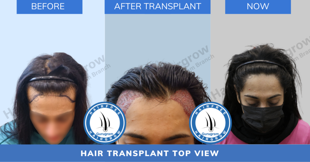 Best hair transplant clinic in Delhi