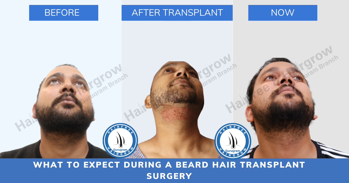 What to Expect During a Beard Hair Transplant Surgery