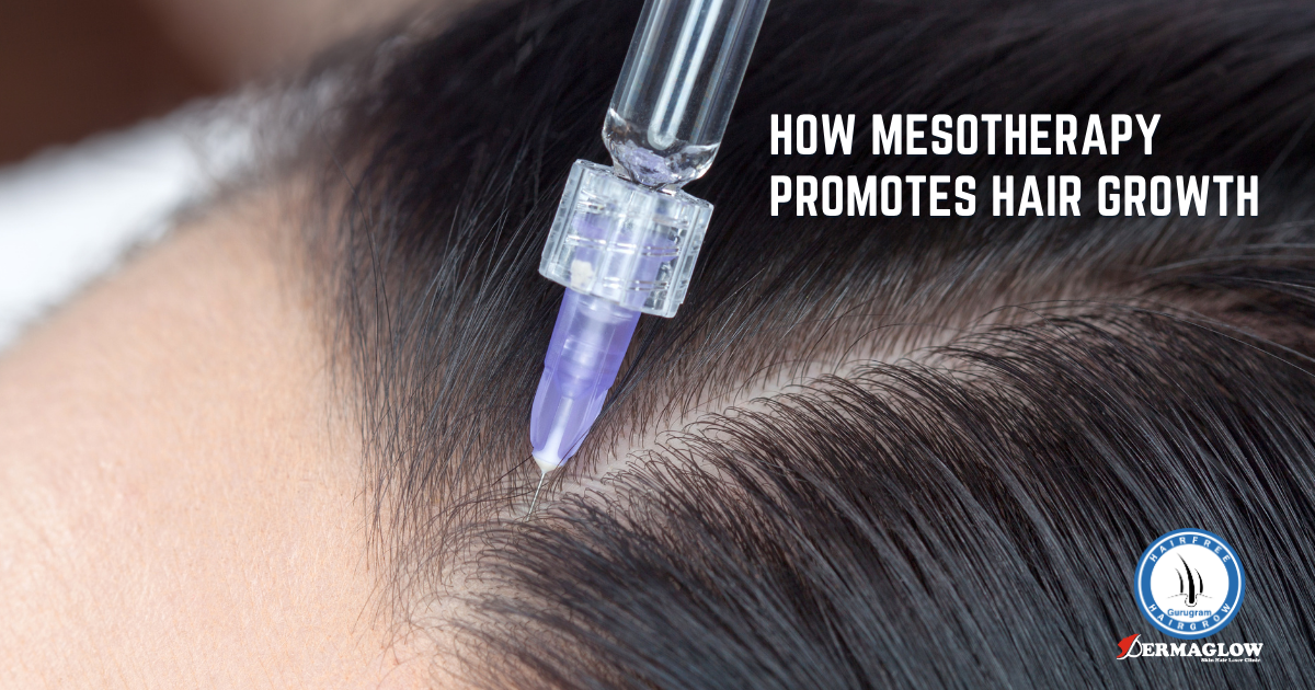 How Mesotherapy Promotes Hair Growth