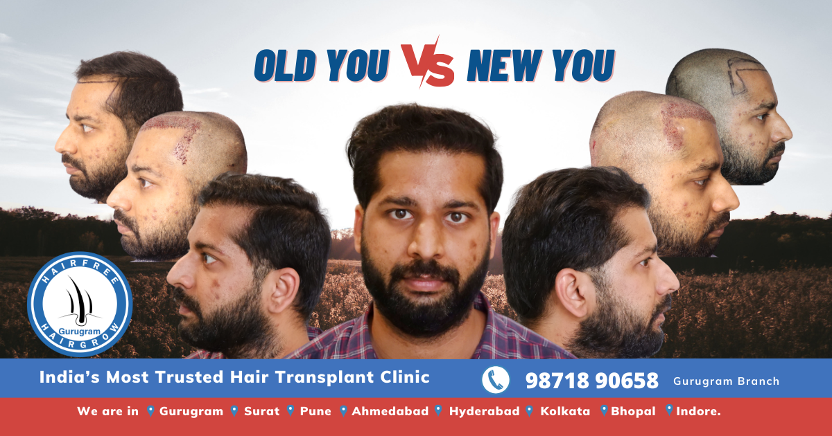 The Journey of a Hair Transplant Patient