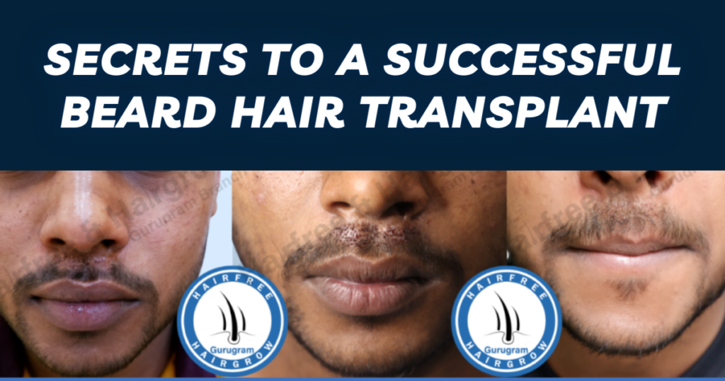 Beard Hair Transplant in Delhi